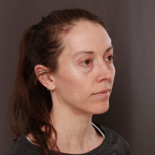 Before Image: Fat Grafting & Lower Blepharoplasty - left-front-oblique