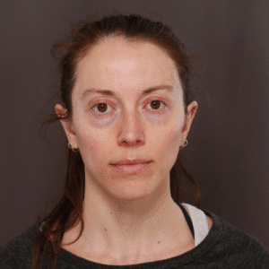 Before Image: Fat Grafting & Lower Blepharoplasty