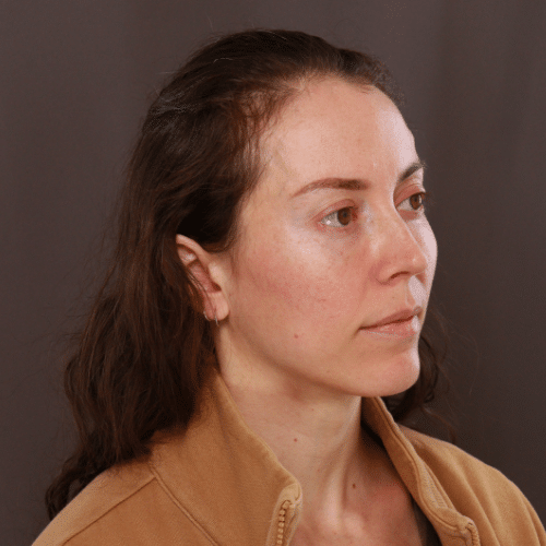 After Image: Fat Grafting & Lower Blepharoplasty - left-front-oblique