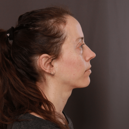 Before Image: Fat Grafting & Lower Blepharoplasty - right-side