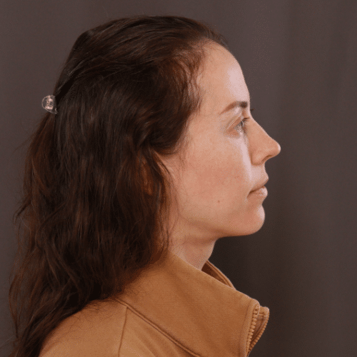 After Image: Fat Grafting & Lower Blepharoplasty - right-side