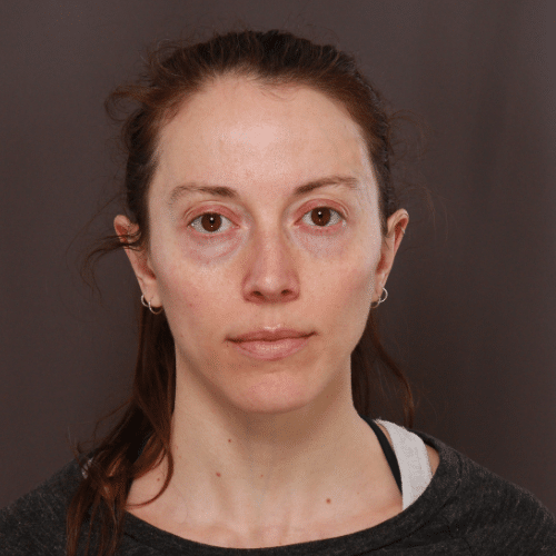 Before Image: Fat Grafting & Lower Blepharoplasty - front