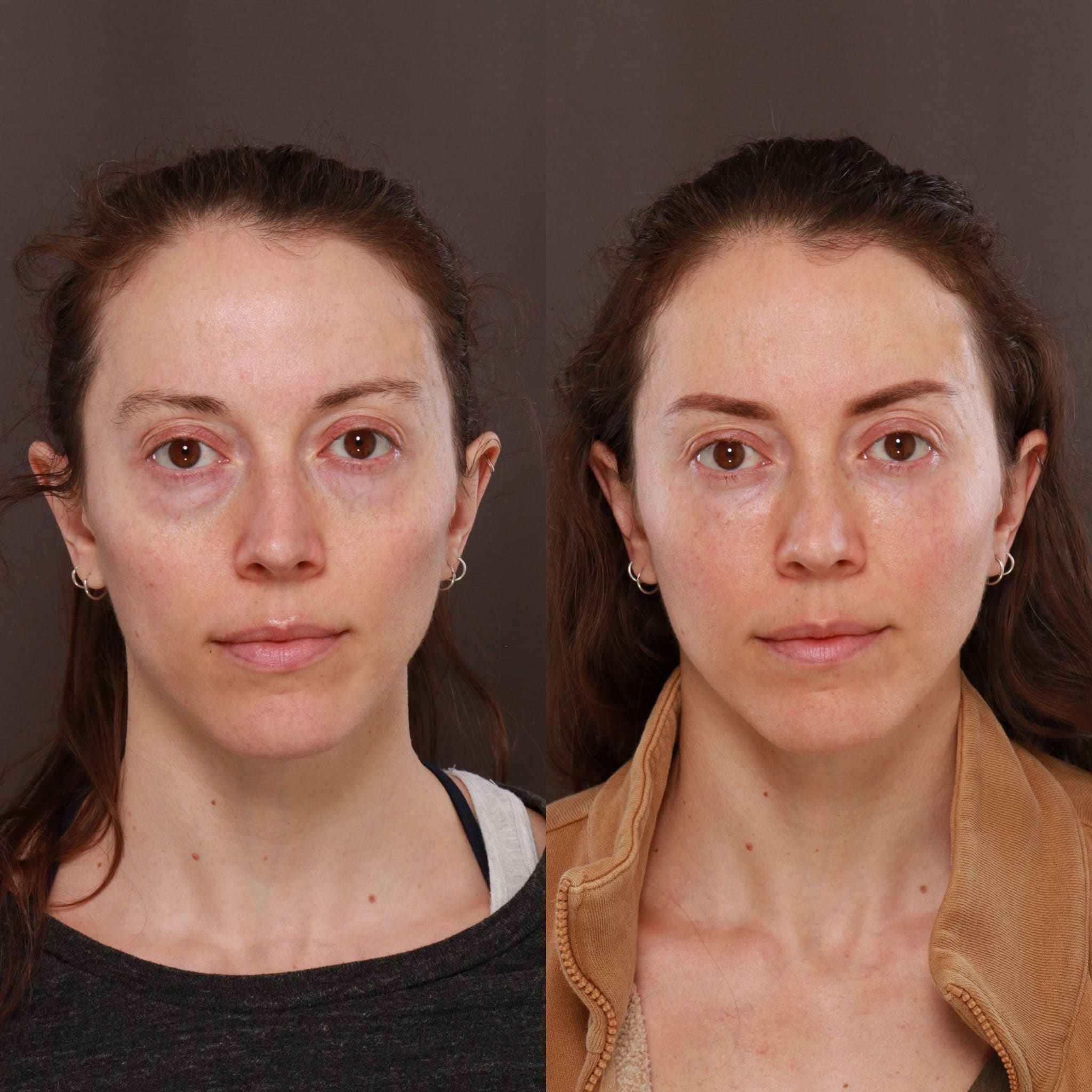 Fat Grafting and Lower Blepharoplasty at Utah Facial Plastics