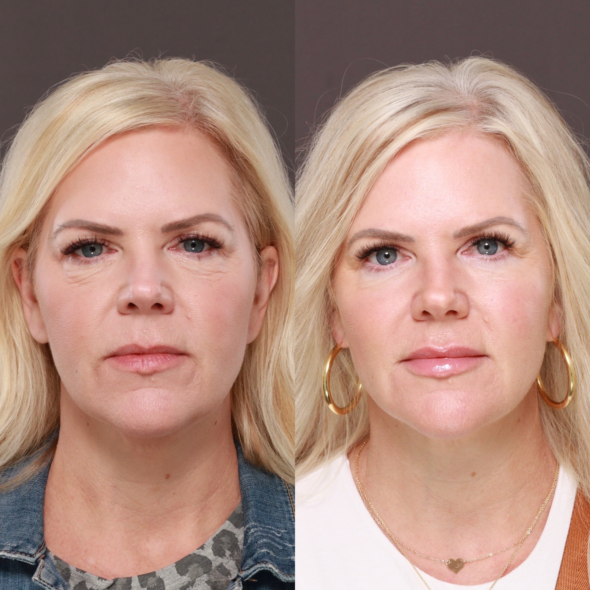 Fat Grafting Utah Facial Plastics