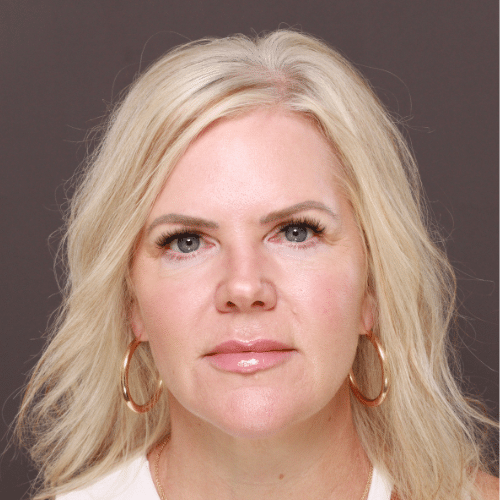 After Image: Lower Blepharoplasty & Fat Transfer - front
