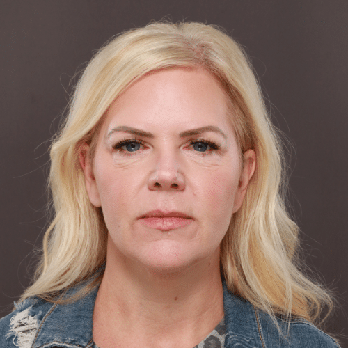Before Image: Lower Blepharoplasty & Fat Transfer - front