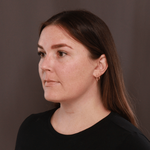 After Image: Lower Face Contouring - left-front-oblique