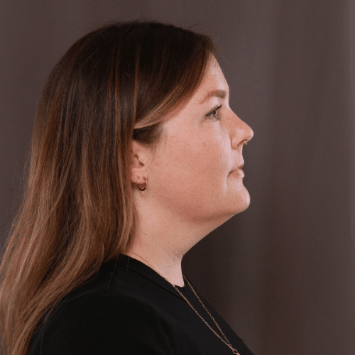 Before Image: Lower Face Contouring - right-side