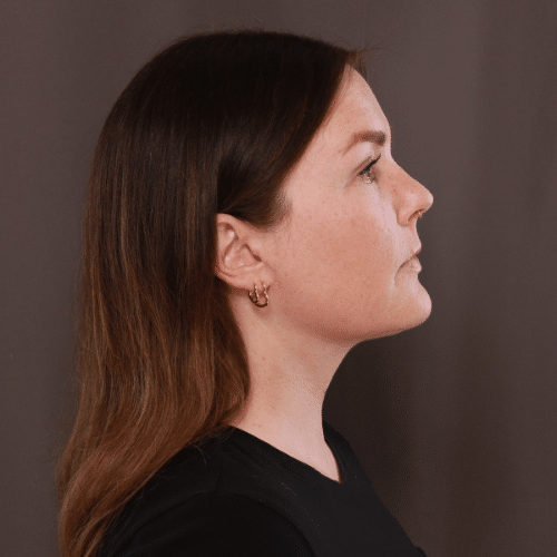 After Image: Lower Face Contouring - right-side