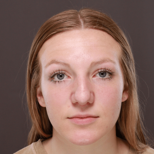 Before Image: Rhinoplasty - front