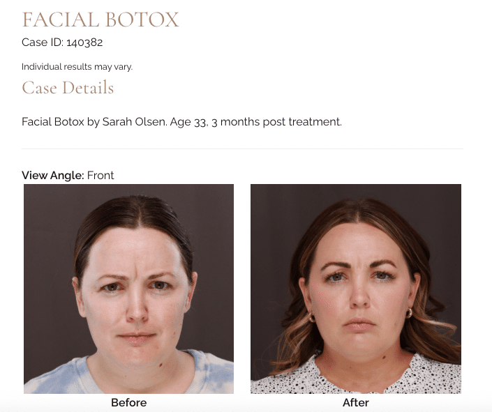 Botox at Utah Facial Plastics