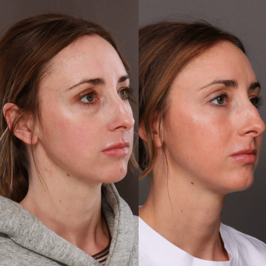 Utah Facial Plastics lower blepharoplasty eyelid lift
