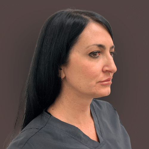 Before Image: Upper Blepharoplasty Eyelid Lift - right-front-oblique
