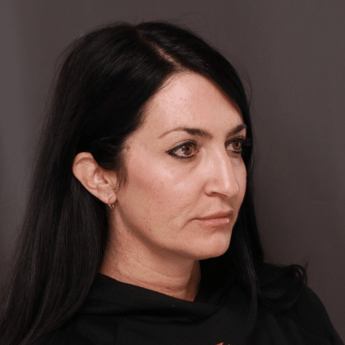 After Image: Upper Blepharoplasty Eyelid Lift - right-front-oblique