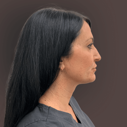 Before Image: Upper Blepharoplasty Eyelid Lift - right-side