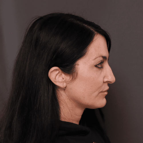 After Image: Upper Blepharoplasty Eyelid Lift - right-side