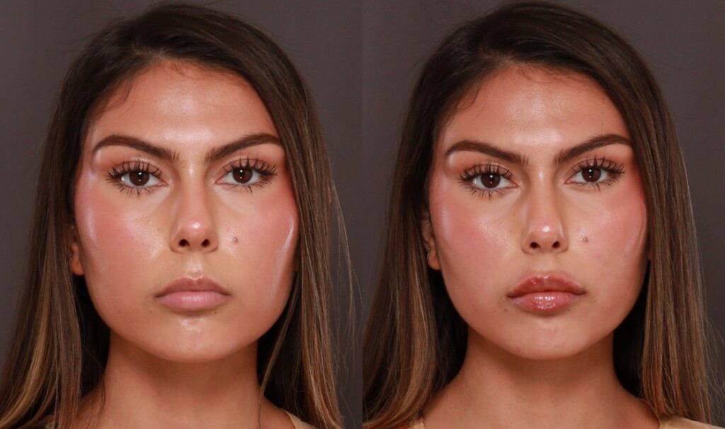 Fillers and Botox at Utah Facial Plastics Heber City Utah (1)