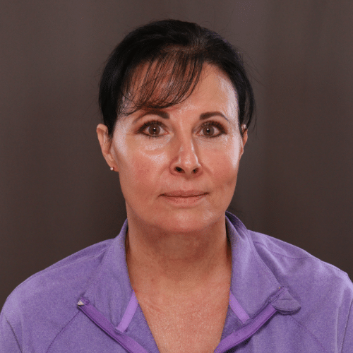 After Image: MACS Lift and Deep Neck Contour -