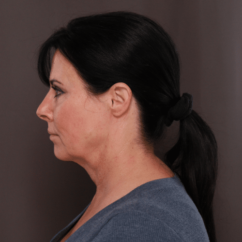 Before Image: MACS Lift and Deep Neck Contour - 