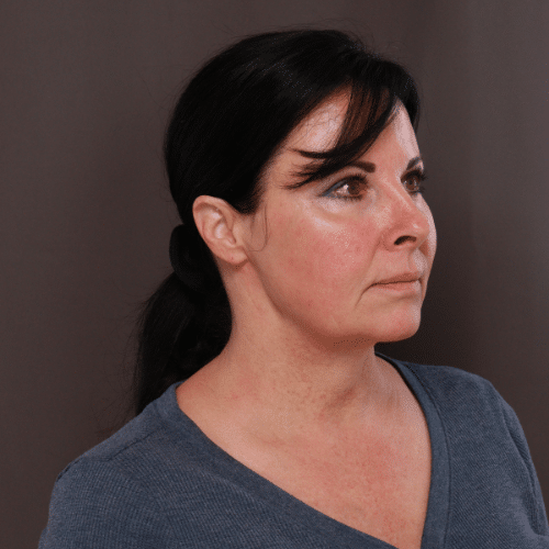 Before Image: MACS Lift and Deep Neck Contour -