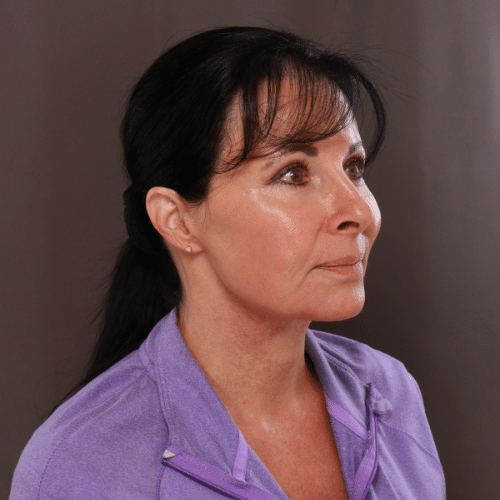 After Image: MACS Lift and Deep Neck Contour -