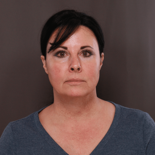 Before Image: MACS Lift and Deep Neck Contour -