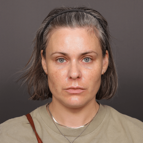After Image: Moxi Laser Treatment - front