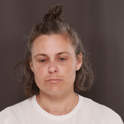 Before Image: Moxi Laser Treatment - front