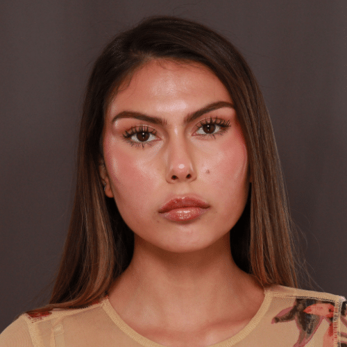 After Image: Lip Enhancement with Filler - front