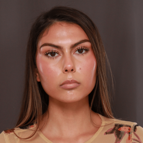 Before Image: Lip Enhancement with Filler - front