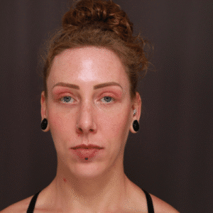 After Image: Eyebrow Lift, Lower Blepharoplasty, and Forehead Reduction