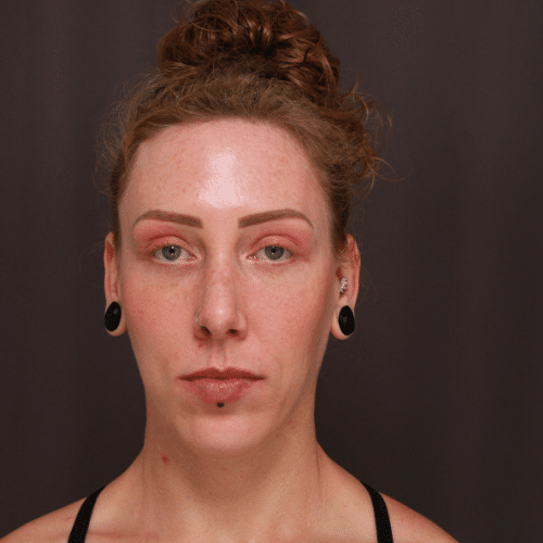 After Image: Eyebrow Lift, Lower Blepharoplasty, and Forehead Reduction - front