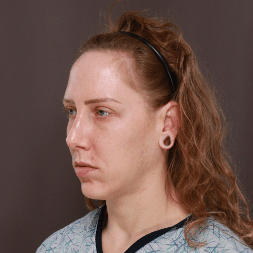 Before Image: Eyebrow Lift, Lower Blepharoplasty, and Forehead Reduction - left-front-oblique