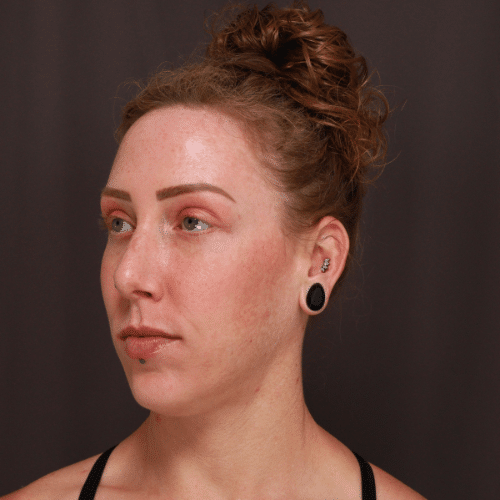 After Image: Eyebrow Lift, Lower Blepharoplasty, and Forehead Reduction - left-front-oblique