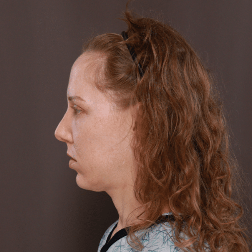 Before Image: Eyebrow Lift, Lower Blepharoplasty, and Forehead Reduction - left-side