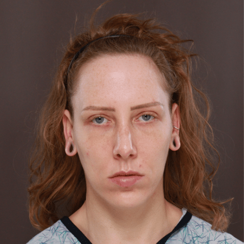Before Image: Eyebrow Lift, Lower Blepharoplasty, and Forehead Reduction - front