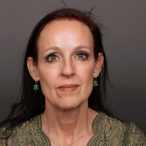 After Image: Brow Lift and Upper Blepharoplasty - front