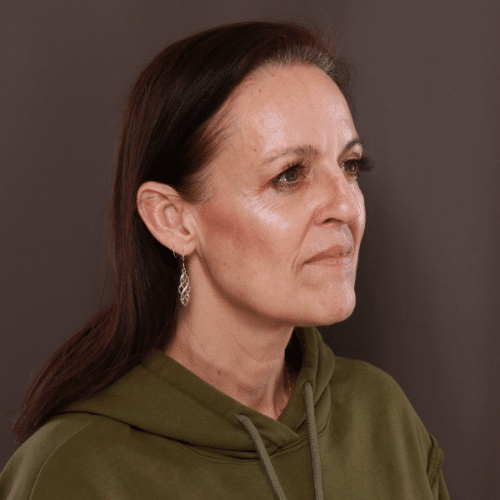 Before Image: Brow Lift and Upper Blepharoplasty - right-front-oblique