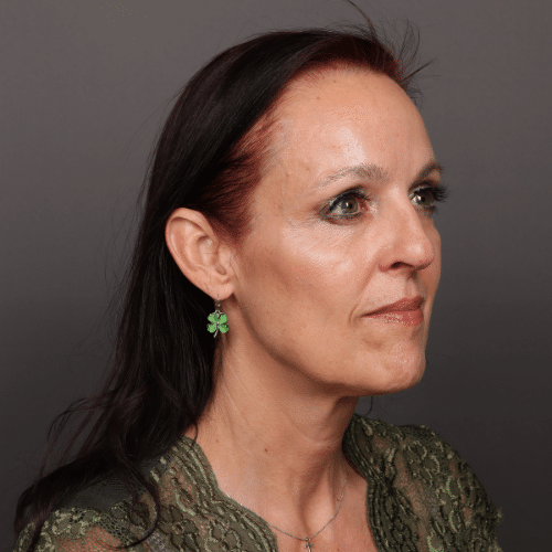 After Image: Brow Lift and Upper Blepharoplasty - right-front-oblique