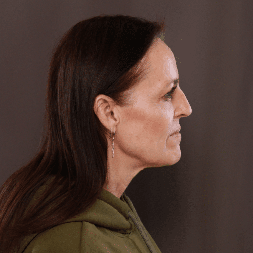 Before Image: Brow Lift and Upper Blepharoplasty - right-side