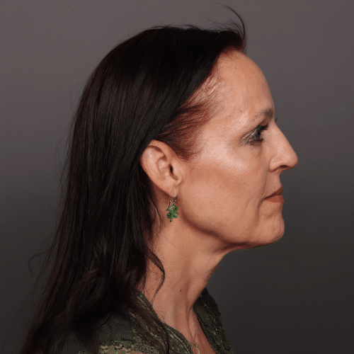 After Image: Brow Lift and Upper Blepharoplasty - right-side