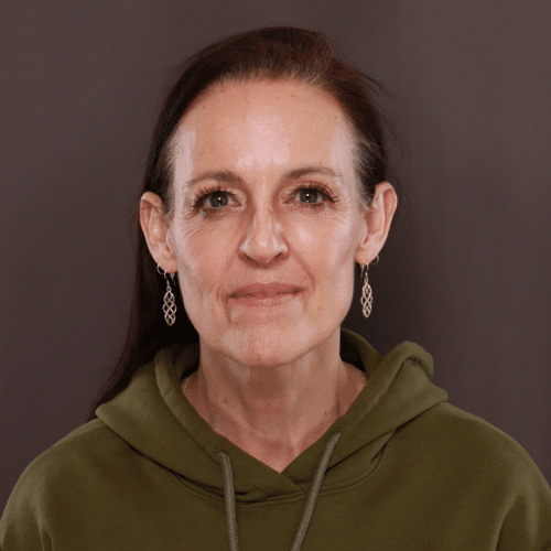 Before Image: Brow Lift and Upper Blepharoplasty - front