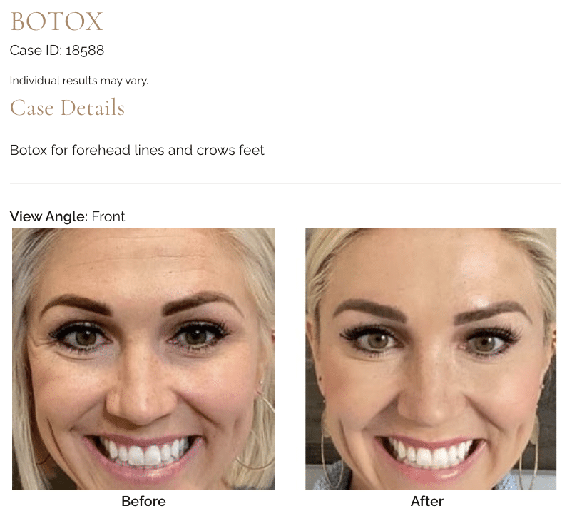 Botox at Utah Facial Plastics