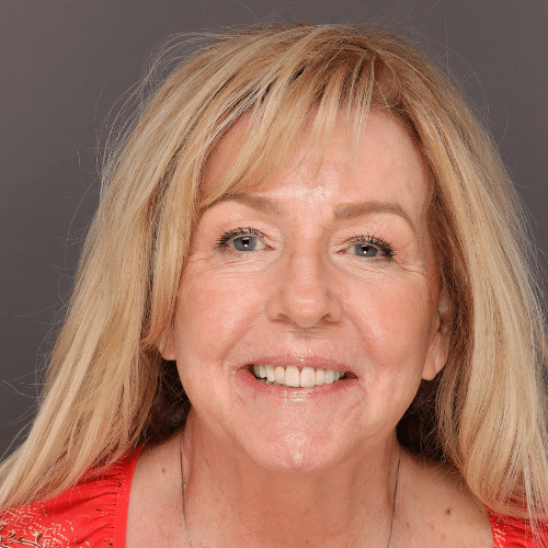After Image: Sylfirm X Laser Treatment - front