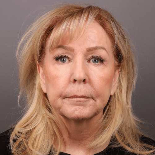 Before Image: Sylfirm X Laser Treatment - front