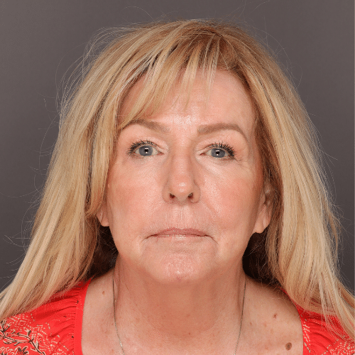 After Image: Sylfirm X Laser Treatment - front