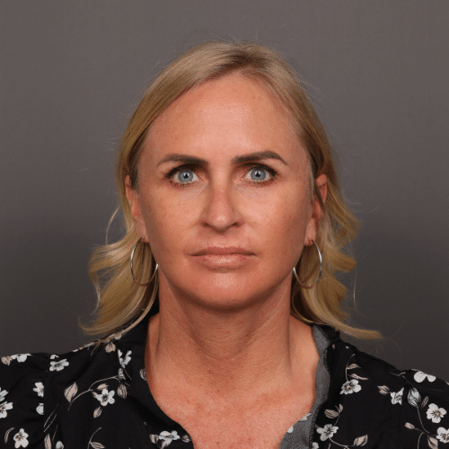 After Image: Facelift & Chin Implant - front