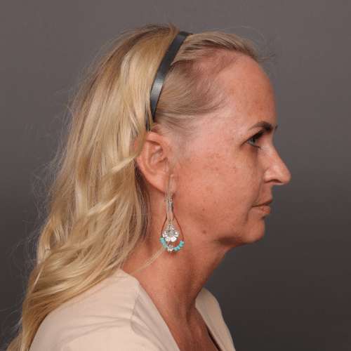 Before Image: Facelift & Chin Implant - right-side