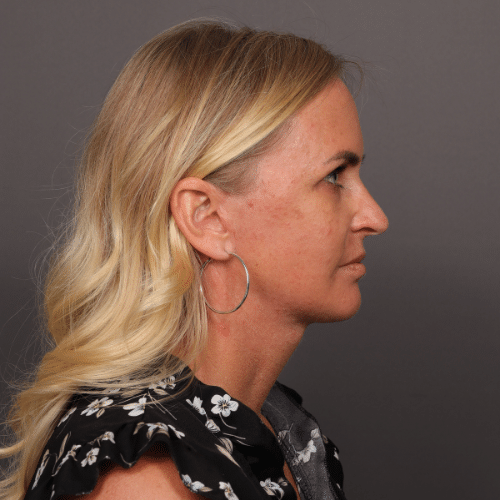 After Image: Facelift & Chin Implant - right-side
