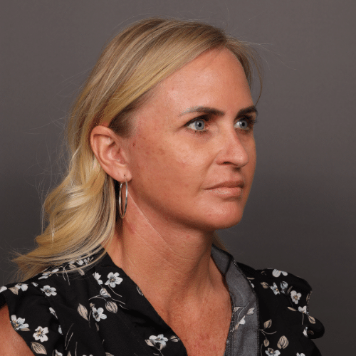 After Image: Facelift & Chin Implant - right-front-oblique